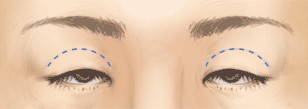 腱膜と瞼板の癒合部分の緩みから起こる眼瞼下垂